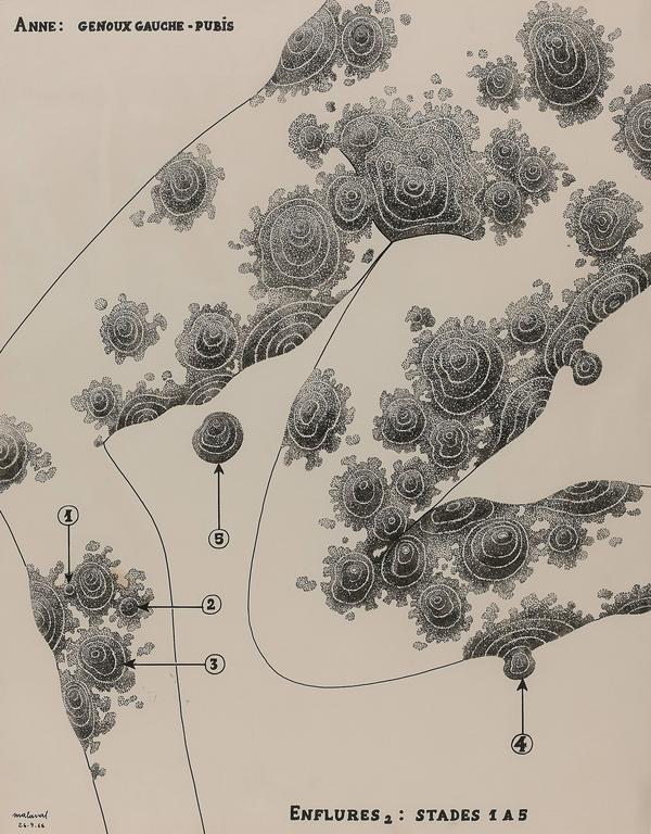 Catalogue raisonné, Robert Malaval, Anne : Genoux gauche - pubis - Enflures 2, stades 1 à 5